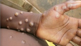 Monkeypox What we know about the smallpoxlike virus spreading in Europe the US and Canada [upl. by Syned]