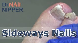 Sideways Toenails Fungal Nails FEETure Friday 2022 [upl. by Leira]