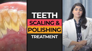 Teeth Scaling amp Polishing in Karachi  HASH DENTAL CLINIC [upl. by Tabb]