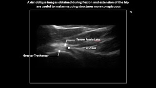 Lateral snapping hip syndrome coxa saltans on dynamic hip ultrasound [upl. by Specht]