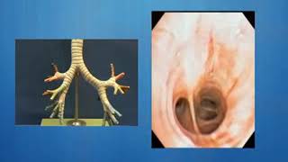 Bronchoscopic view of the Airway [upl. by Matias]