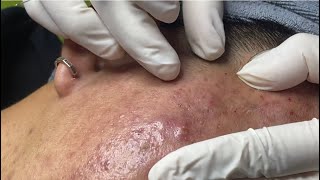 Acne treatment for Spa Linh Mun 2024 34 [upl. by Rufina]