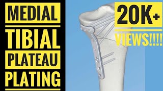 Medial Approach and Plating of Medial Tibial Condyle [upl. by Gaddi]