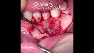 Impacted Tooth [upl. by Om]