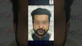 Best Hair Transplant Clinic In Chandigarh  Neograft  Hairtransplantinchandigarh [upl. by Aloisia]