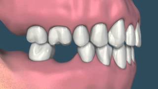 Efeito da perda dentária Extração 46 mesialização do 47 extrusão superior [upl. by Oicanata]