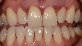 Treatment of Advanced Periodontal Gum Disease with Non surgical and Surgical Periodontal Therapy [upl. by Kylah]