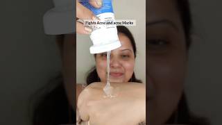 Get Rid of Acne and Acne Marks in 2 steps oilyskintreatment oilyskin skincare [upl. by Biagio904]