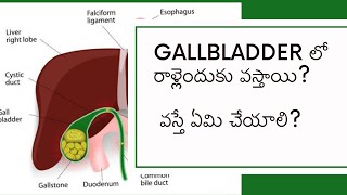 Gallbladder Stones Causes Symptoms and Treatment Options Explained gallstones [upl. by Evilc]