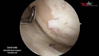 What Does Arthritis of The Knee Joint Look Like [upl. by Ainej]