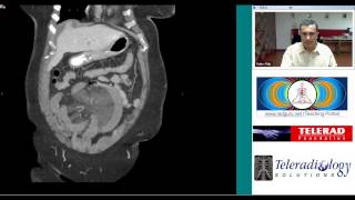 Superior Mesenteric Vein Thrombosis by Dr Arjun Kalyanpur [upl. by Sumerlin]