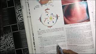 episcleritis in hindi  youtube  video [upl. by Edda]