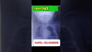 KlippelFeil Syndrome  Congenital Musculoskeletal Disorder medicalstudent mbbs doctor [upl. by Rhody67]