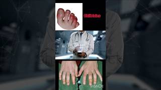 Chilblains Swelling in hands and feet [upl. by Larissa]