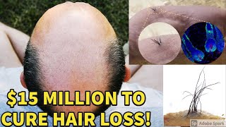 THIS COMPANY RECEIVED A WHOPPING 15 MILLION TO CURE HAIR LOSS Better Than DR TSUJI [upl. by Isidora731]