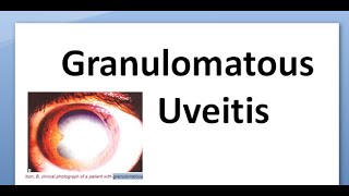 Ophthalmology 162 a Granulomatous uveitis chronic mutton fat keratic precipitates Tubercular VKH [upl. by Carpenter]