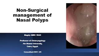 Nasal Polyps Surgery is not always the best option [upl. by Manchester297]