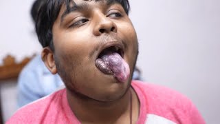 Poor boy with large hemangioma in tongue and lips [upl. by Harelda]