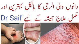 Kharish Ka Fori Ilaj  kharish ka ilaj and medicine  allergy ki best medicine dano wali allergy [upl. by Anavlys229]