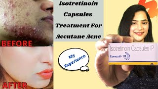 My Experience With Isotretinoin Isotretinoin Capsule for acneBefore amp AfterBenefitsSide Effects [upl. by Inverson]