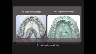 Ridge augmentation with BMP2  26 with implant placement [upl. by Huberto]