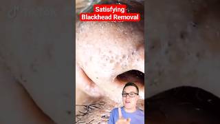 Crazy BLACKHEAD REMOVAL  Blackhead Extraction shorts [upl. by Odoric]