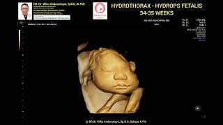 Hydrothorax  Hydrops fetalis 3435 weeks [upl. by Jenette901]