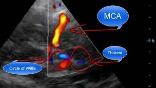 Transcranial Doppler Point of Care Ultrasound [upl. by Demetra]