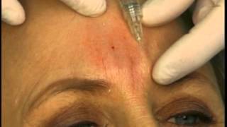 Dr Elliott Shows How to Fill Frown Glabella Lines With A Dermal Filler [upl. by Orlena357]