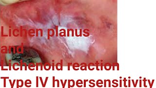 Difference between Lichen planus and Lichenoid reaction pathogenesis of lichen planus and lichenoid [upl. by Ramuk]