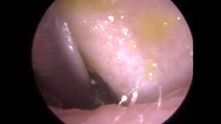 271  Ear Wax Removal using Jobson Horne Zoellner Sucker and Sodium Bicarbonate [upl. by Ringler]