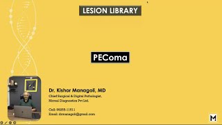 Pathology of PEComa [upl. by Oriaj]