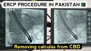 ercp stent procedure video  ercp test video in hindi Ercp in pakistan [upl. by Jyoti]