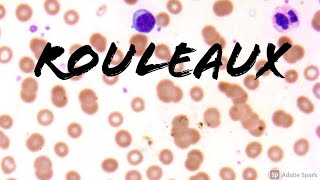 Rouleaux Formation Erythrocytes on Peripheral Blood Smear in Multiple Myeloma Hemepath Hematology [upl. by Sylirama]