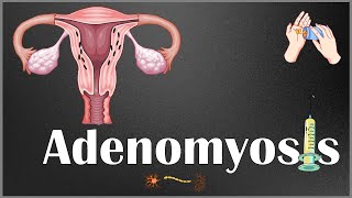 Adenomyosis  Definition Causes Risk Factors Signs amp Symptoms Diagnosis amp Treatment [upl. by Earlie]