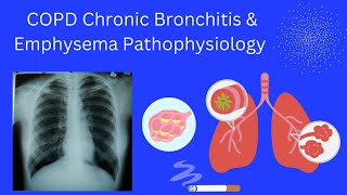 COPD Chronic Bronchitis amp Emphysema Pathophysiology [upl. by Targett531]