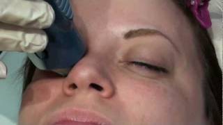 Does Thermage Skin Tightening Laser Treatment hurt [upl. by Inalak]