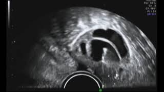 Egg Retrieval During IVF [upl. by Landel]