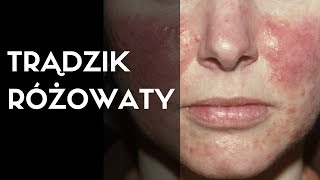 Dermatolog mówi o TRĄDZIK RÓŻOWATY [upl. by Airehc]