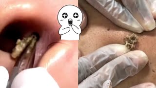 Ultimate Compilation Satisfying Blackhead Removal and Acne Treatment Highlights [upl. by Etnwahs765]