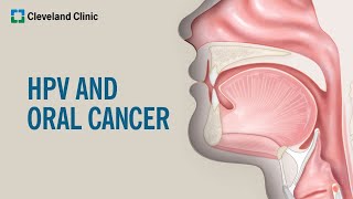 What Is HPVRelated Oral Cancer [upl. by Filbert]