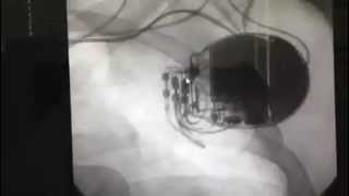 Video 531  Interventional Cardiac Electrophlysiology [upl. by Nida410]