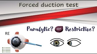 Forced duction test │Active force generation test [upl. by Ecirbaf]