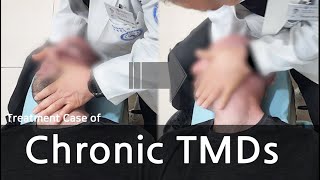 Chronic TMDs  TMJ sound amp pain  facial tremor body imbalance facial asymmetry  만성 턱관절장애  턱소리 [upl. by Aslam]