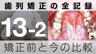 矯正前と1年後の変化を比較 えっ！こんなに動くの！？｜歯列矯正の全記録132 [upl. by Cyler]