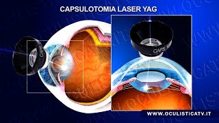 Cataratta secondaria capsulotomia laser YAG [upl. by Eikkin]