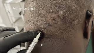 Intralesional Steroid Injections for Acne Keloidalis Nuchae rejuvenceclinic91 [upl. by Klimesh]