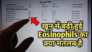 Eosinophils high in blood test means eosinophilia High Eosinophils cbc Blood test in hindi [upl. by Eceinahs]