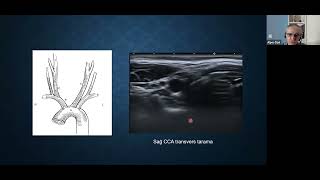 26 Şubat 2024 TNRD Toplantısı Konu Karotis ve Vertebral Arter Doppler Ultrasonografi [upl. by Chuck]