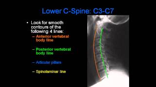 Radiology of Spine Trauma [upl. by Jaehne]